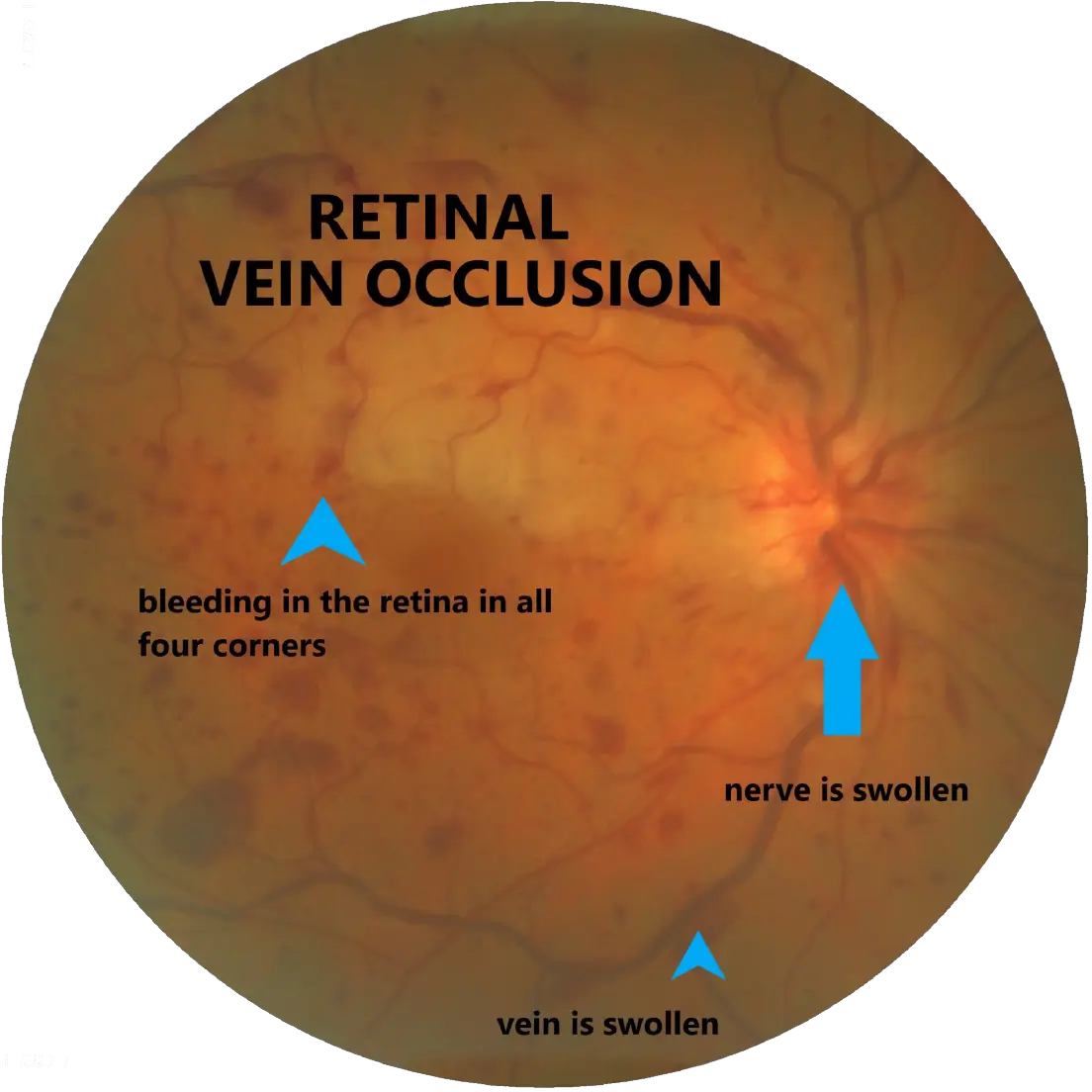 Retina Vein Occlusion  Problem